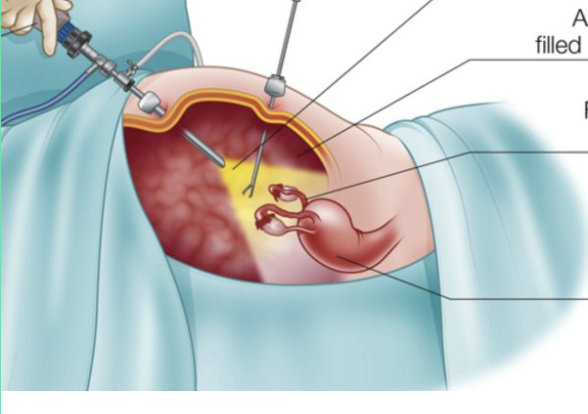 Laparoscopic Hysterectomy - Specialist Gynaecology Treatment at First Care Clinic